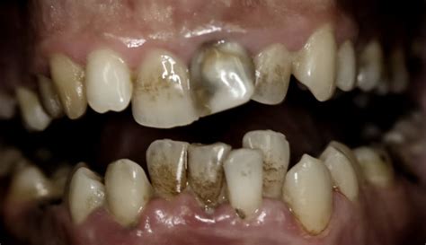 dientes podridos-4